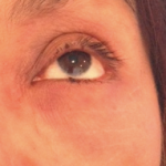 Blefaroplastia