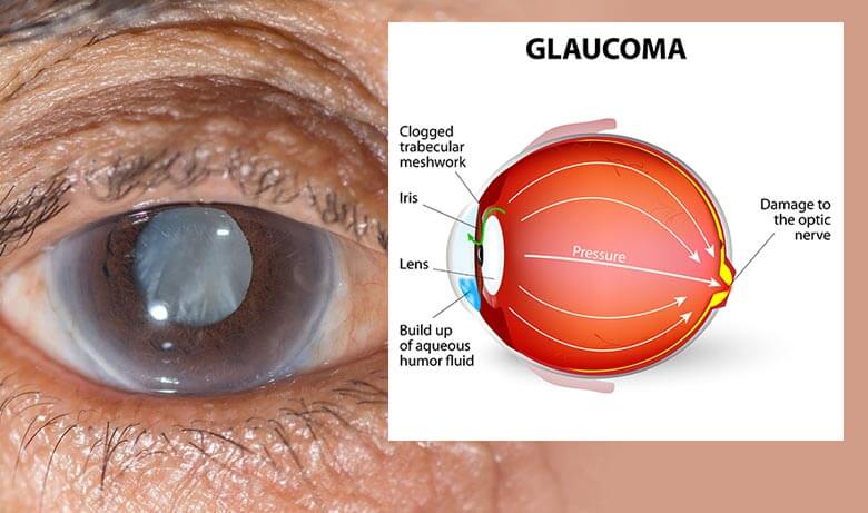 Glaucoma